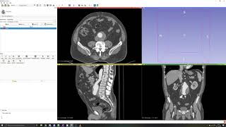 3D Slicer Tutorial 2 Manual segmentation Thresholding [upl. by Egwan]