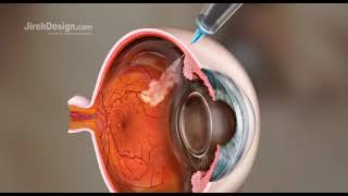 Intravitreal Injection Animation HD [upl. by Turmel176]