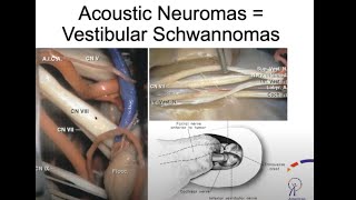 A Rare Brain Tumor Affecting Hearing amp Balance  Acoustic Neuroma [upl. by Edyth]