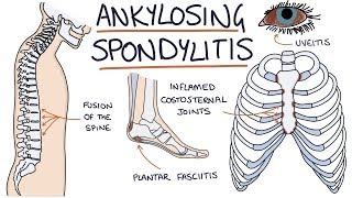 Ankylosing Spondylitis Visual Explanation for Students [upl. by Leber]