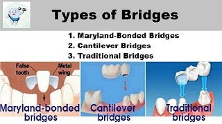 Types Of Dental Bridges [upl. by Ecnedurp294]