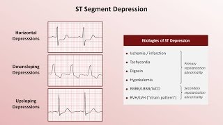 Intro to EKG Interpretation  QRST Changes [upl. by Iznek]