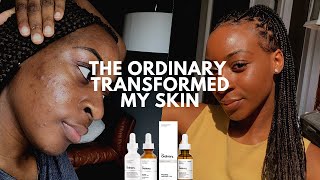 The Ordinary Skin Transformation Mandelic Acid Cleared My Acne  xoreni [upl. by Barmen435]