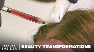 How To Restore Hair Growth With PlateletRich Fibrin  Beauty Transformations [upl. by Norven977]