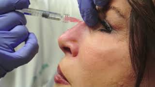 Nonsurgical Rhinoplasty [upl. by Saffier640]