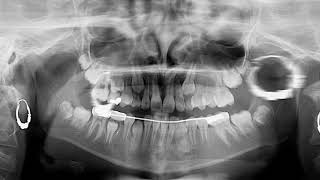 Can You Determine The Patients Age On Panoramic Radiograph [upl. by Nileak]