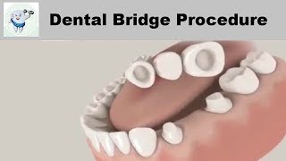 Dental Crown Bridge Procedure  Fixed Teeth [upl. by Livi]