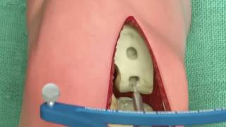 Animated Video of NAVIO Total Knee Replacement [upl. by Tertias]