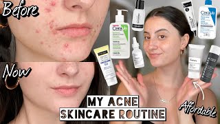 How I Cleared My HORMONAL ACNE amp SCARRING with Affordable Skincare  Dry amp Sensitive Skin [upl. by Asiled]