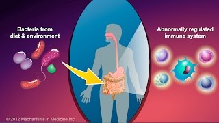 Enfermedad inflamatoria intestinal 3 patogenia [upl. by Kyl767]