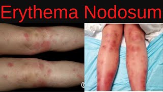 Erythema Nodosum Symptoms Causes Diagnosis Treatment Infections Medications [upl. by Norda740]