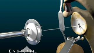 Evolutis Reverse Shoulder surgery Animated Version [upl. by Corrie]