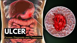 Ulcerative colitis  Morphology Clinical features difference from Crohn disease [upl. by Flavio]