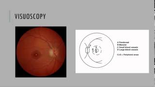 Visuoscopy Fixation Ophthalmoscopy [upl. by Crotty]