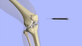 Knee Joint Injection [upl. by Saks]