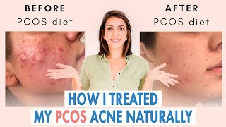 How I Healed My Cystic Acne NATURALLY PCOS amp Hormonal Acne [upl. by Onit]