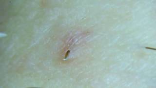 Gross Removing an ingrown pubic hair [upl. by Annairdua]