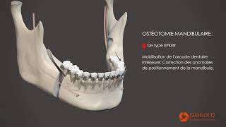 CMF  Film patient  Clivage Sagittal [upl. by Hamlen]