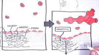 Polyarteritis Nodosa and Kawasaki Disease Medium Vessel Vasculitis  Symptoms pathophysiology [upl. by Hartnett314]