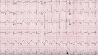 Q Wavein STEMI NSTEMI normal amp pathological [upl. by Teresa375]