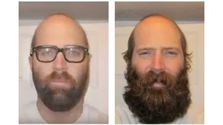 THICKEST BEARD 6 MONTH TIMELAPSE [upl. by Faythe280]