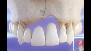 Implant dentaire vs Pont dentaire  Comparaison © [upl. by Vitia453]