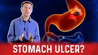 How To Get Rid Of Stomach Ulcer – DrBerg On Peptic Ulcer Treatment [upl. by Nidorf]