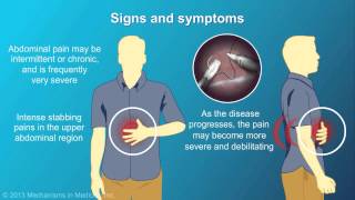 Chronic Pancreatitis [upl. by Haidadej386]