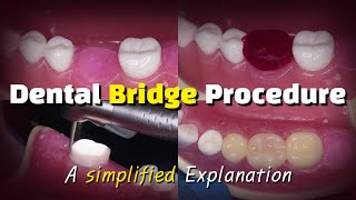 Dental Bridge Procedure [upl. by Attenauqa]