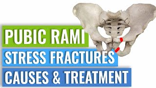 Pubic Ramus Stress Fractures Treatment [upl. by Caiaphas983]