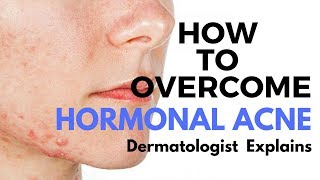 Skin Care Tips Treating HORMONAL ACNE [upl. by Lyrak600]