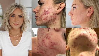 How I Cured My Adult Hormonal Cystic Acne Naturally no accutane [upl. by Ahsenot]